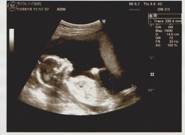 エコー写真 18週2日 18w2d 女の子,妊娠18週,エコー,