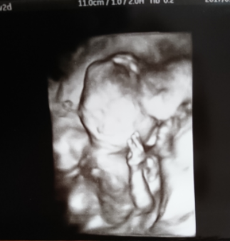 エコー写真 18週2日 18w2d 女の子,妊娠18週,エコー,