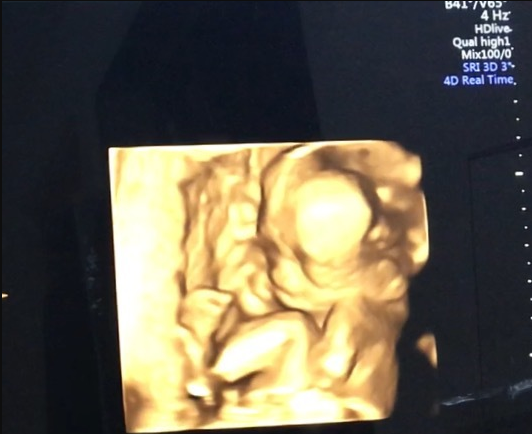 エコー写真 18週3日 18w3d 男の子,妊娠18週,エコー,