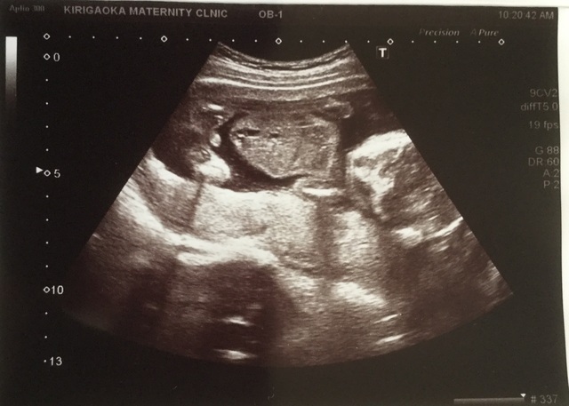 エコー写真 18週3日 18w3d 男の子,妊娠18週,エコー,