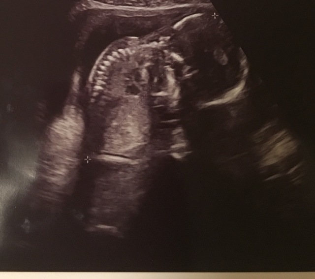 エコー写真 18週3日 18w3d 女の子,妊娠18週,エコー,