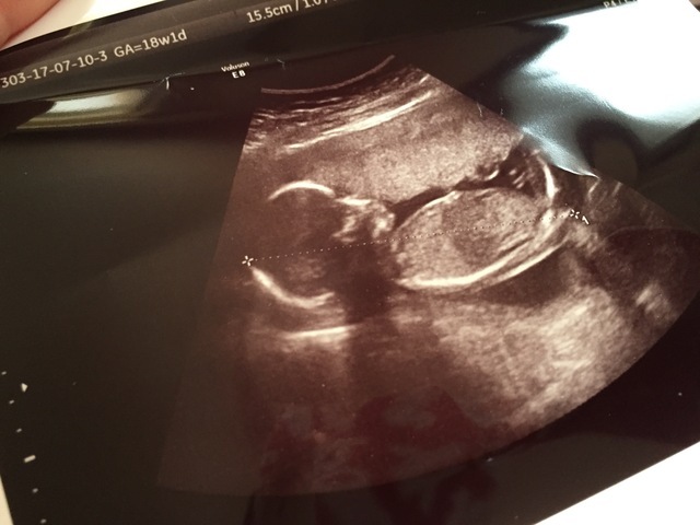 エコー写真 18週4日 18w4d 男の子,妊娠18週,エコー,
