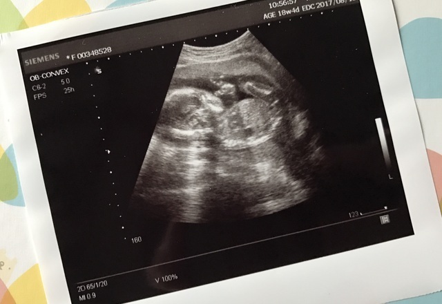 エコー写真 18週4日 18w4d 女の子,妊娠18週,エコー,