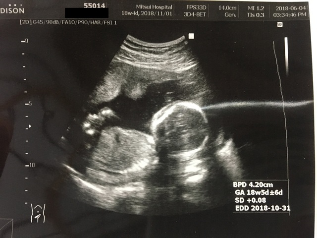 エコー写真 18週4日 18w4d 女の子,妊娠18週,エコー,