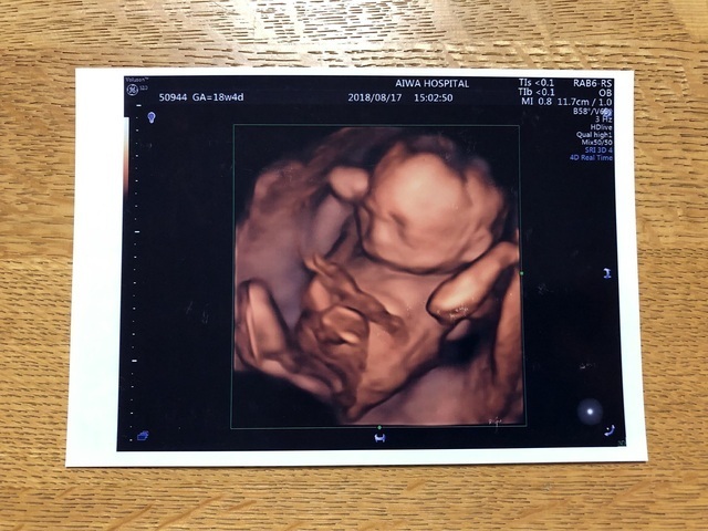 エコー写真 18週4日 18w4d 男の子,妊娠18週,エコー,