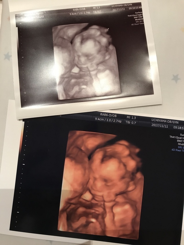 エコー写真 18週4日 18w4d 男の子,妊娠18週,エコー,