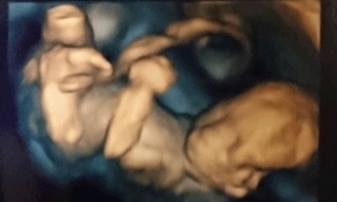 エコー写真 18週5日 18w5d 男の子,妊娠18週,エコー,