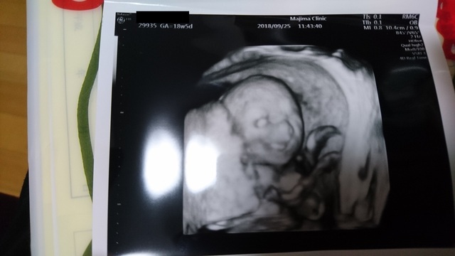 エコー写真 18週5日 18w5d 女の子,妊娠18週,エコー,