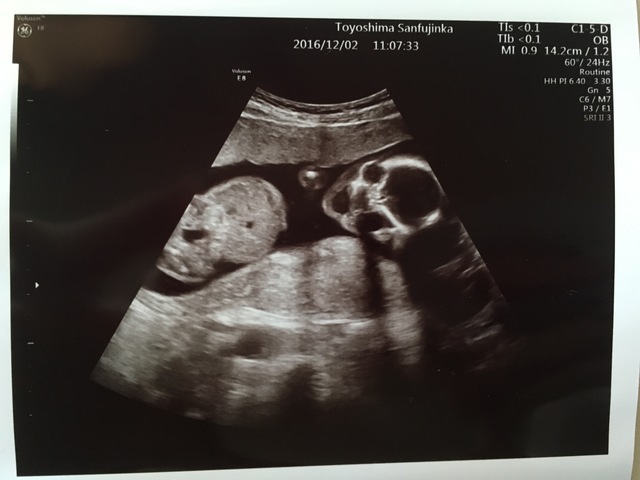 エコー写真 18週6日 18w6d 男の子,妊娠18週,エコー,