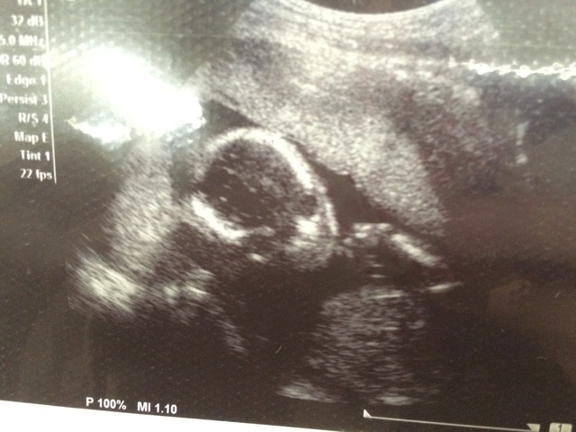エコー写真 18週6日 18w6d 女の子,妊娠18週,エコー,