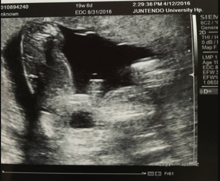 エコー写真 20週0日 20w0d 男の子,妊娠20週,エコー,