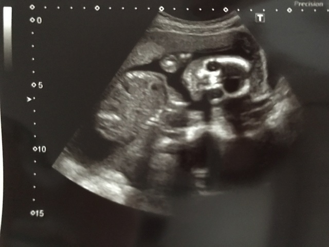 エコー写真 20週1日 20w1d 性別不明,妊娠20週,エコー,