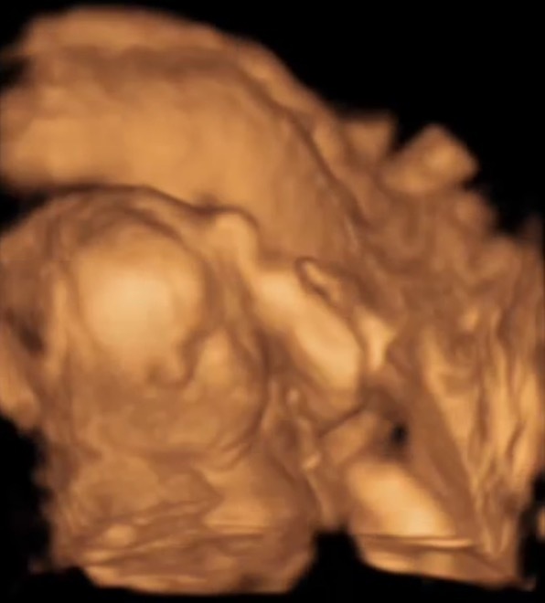 エコー写真 20週1日 20w1d 女の子,妊娠20週,エコー,