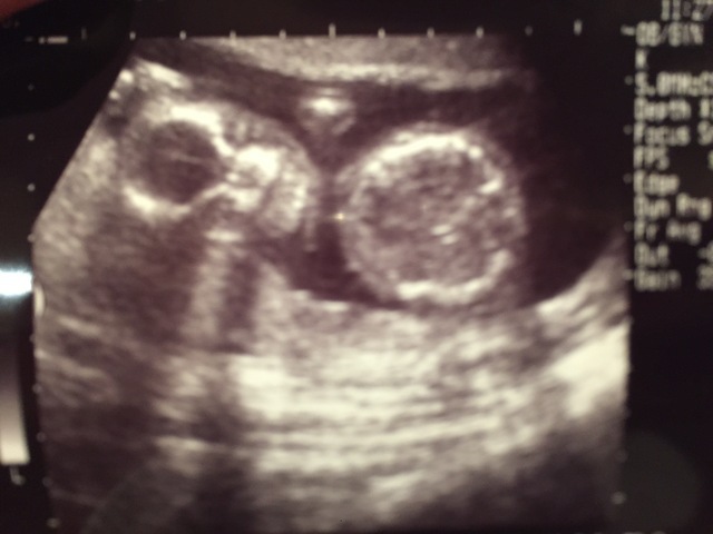 エコー写真 20週1日 20w1d 男の子,妊娠20週,エコー,