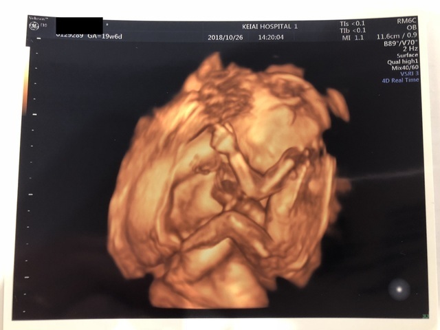 エコー写真 20週1日 20w1d 女の子,妊娠20週,エコー,