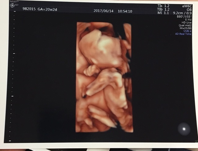 エコー写真 20週2日 20w2d 女の子,妊娠20週,エコー,