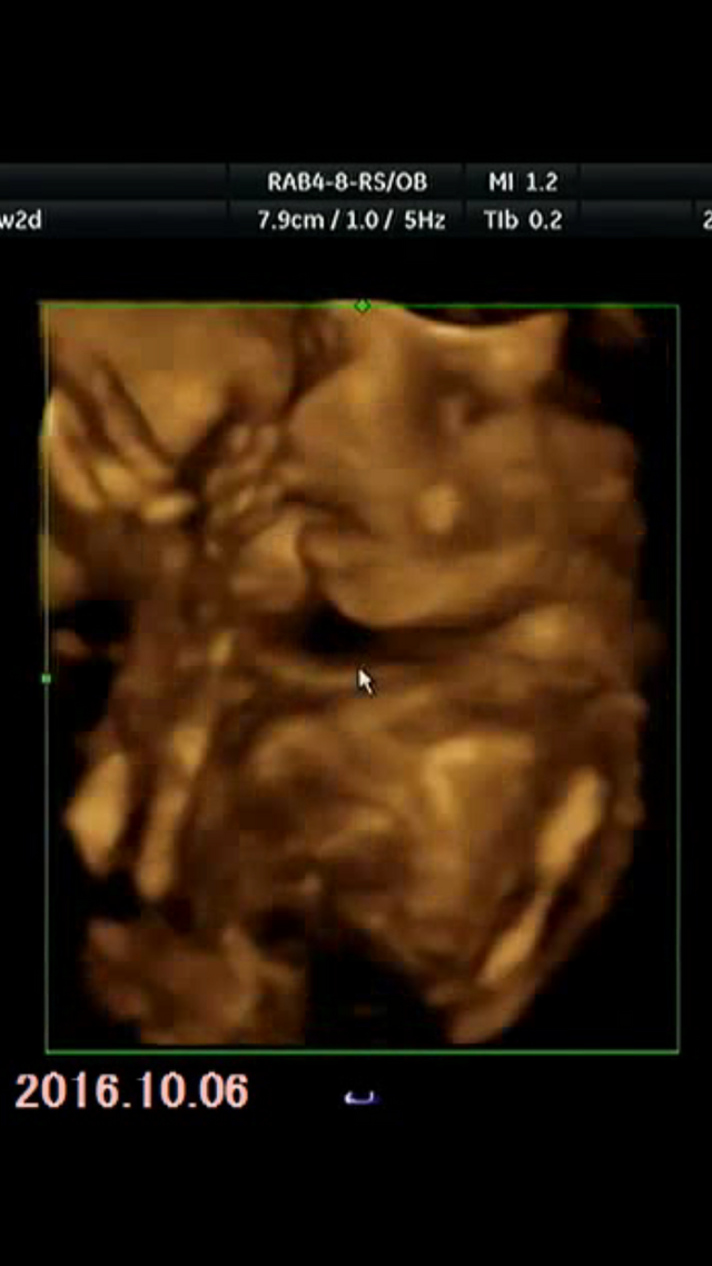 エコー写真 20週2日 20w2d 女の子,妊娠20週,エコー,