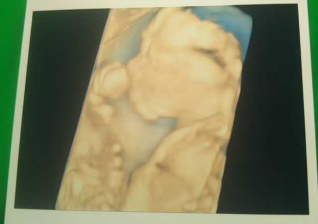 エコー写真 20週2日 20w2d 男の子,妊娠20週,エコー,