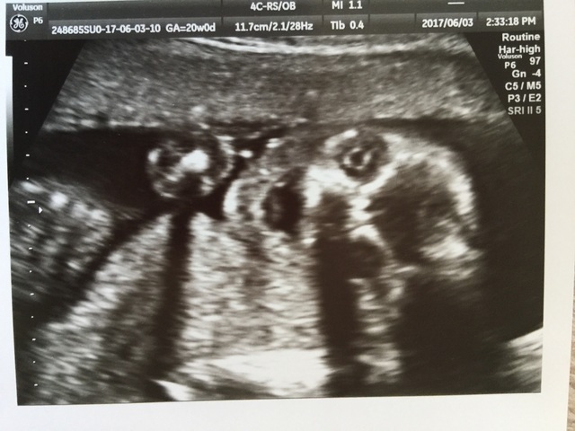 エコー写真 20週2日 20w2d 女の子,妊娠20週,エコー,