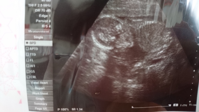 エコー写真 20週2日 20w2d 女の子,妊娠20週,エコー,