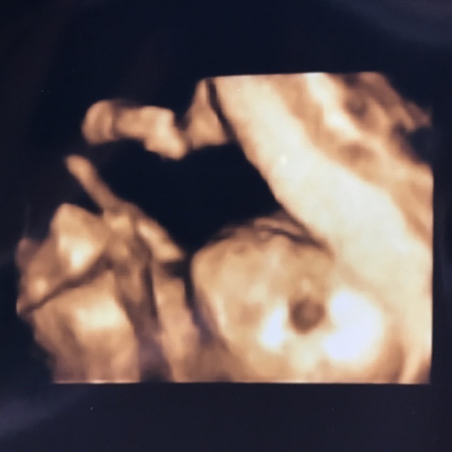 エコー写真 20週2日 20w2d 男の子,妊娠20週,エコー,