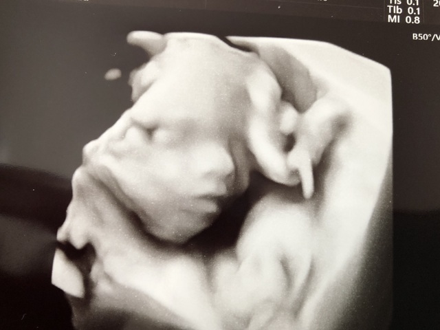 エコー写真 20週2日 20w2d 男の子,妊娠20週,エコー,