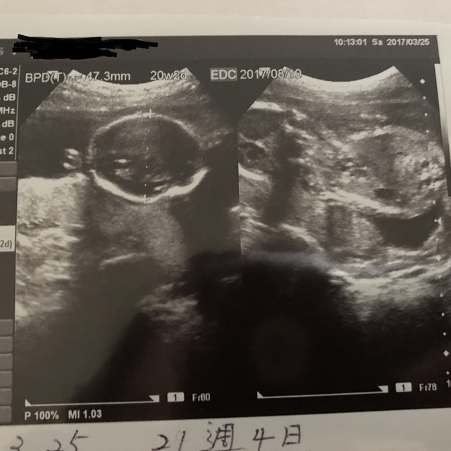 エコー写真 20週4日 20w4d 女の子,妊娠20週,エコー,