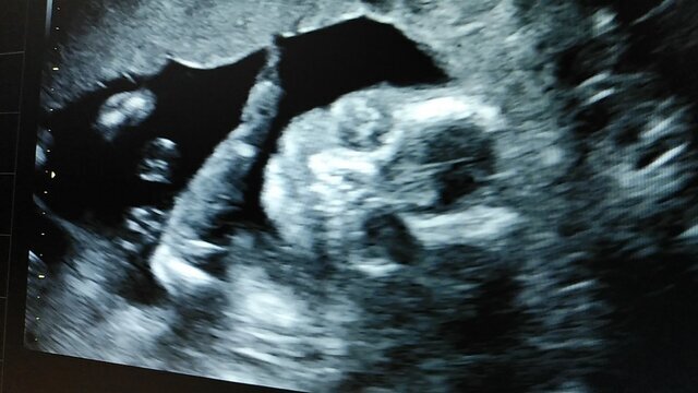 エコー写真 20週4日 20w4d 女の子,妊娠20週,エコー,