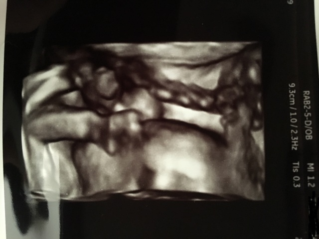 エコー写真 20週5日 20w5d 男の子,妊娠20週,エコー,