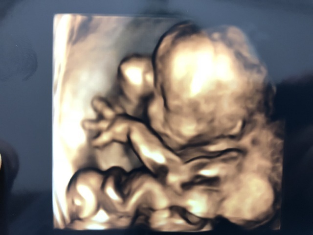 エコー写真 20週5日 20w5d 男の子,妊娠20週,エコー,