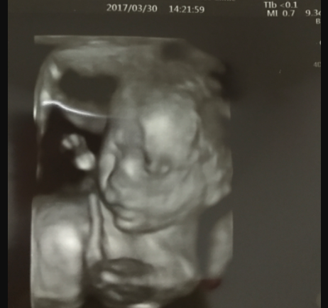 エコー写真 20週6日 20w0d 男の子,妊娠20週,エコー,