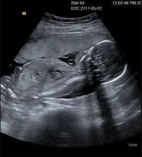 エコー写真 20週6日 20w6d 女の子,妊娠20週,エコー,