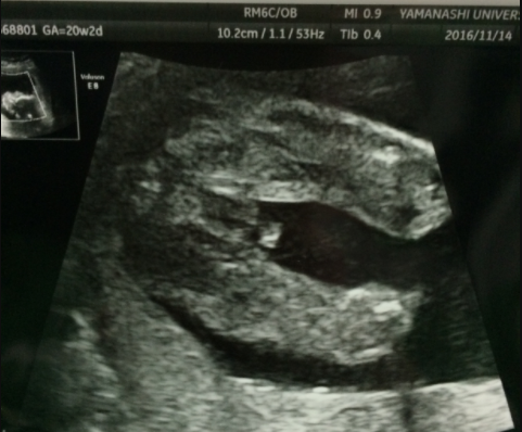 エコー写真 20週6日 20w6d 男の子,妊娠20週,エコー,