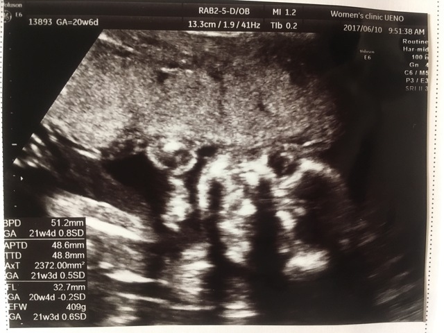 エコー写真 20週6日 20w6d 女の子,妊娠20週,エコー,