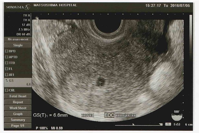 エコー写真 4w0d 妊娠4週,妊娠4週,エコー,
