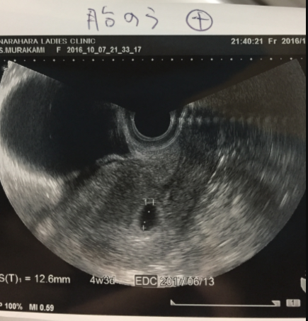 エコー写真 4w3d 妊娠4週,妊娠4週,エコー,