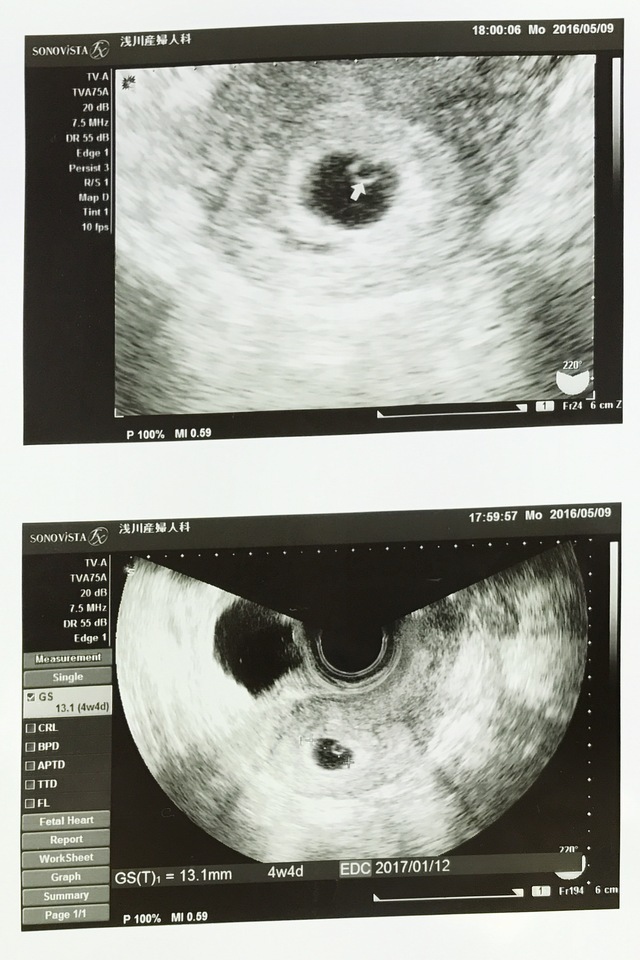 エコー写真 4w4d 妊娠4週,妊娠4週,エコー,