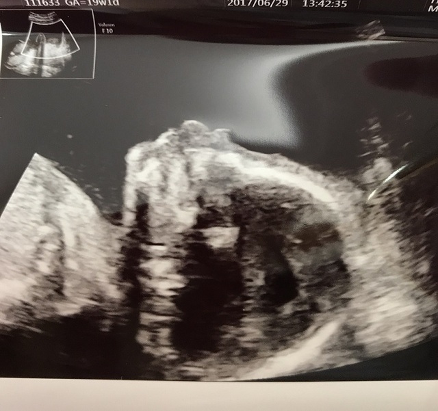 エコー写真 19週1日 19w1d 性別不明,妊娠19週,エコー,