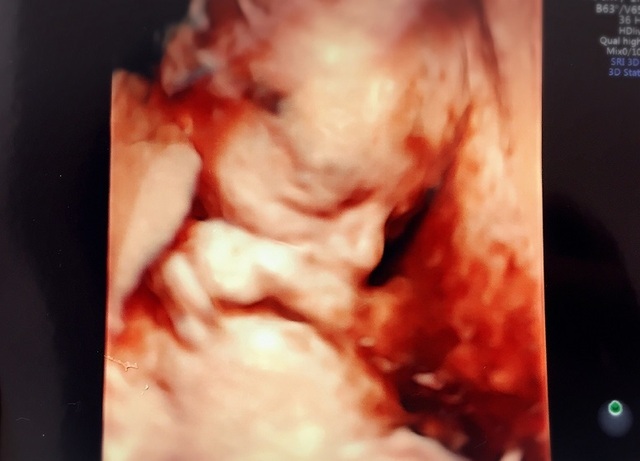 エコー写真 19週1日 19w1d 女の子,妊娠19週,エコー,