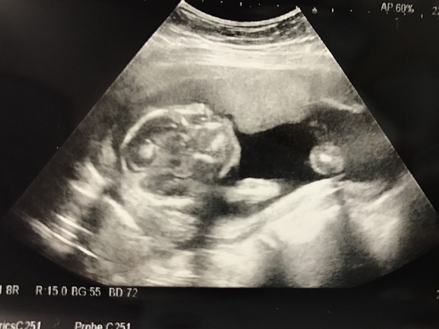 エコー写真 19週2日 19w2d 女の子,妊娠19週,エコー,