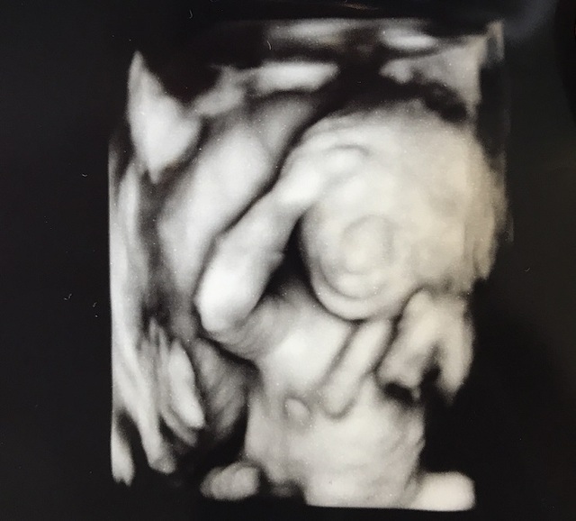 エコー写真 X週X日 XwXd 女の子/男の子,妊娠19週,エコー,