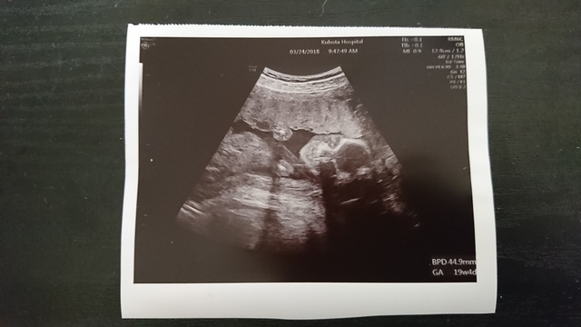 エコー写真 19週1日 19w1d 女の子,妊娠19週,エコー,