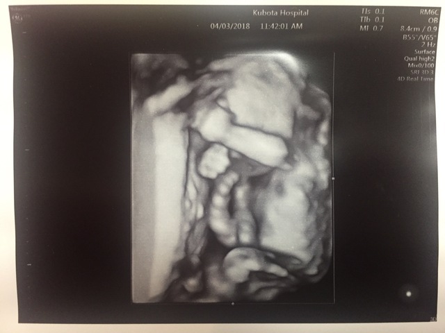 エコー写真 19週5日 19w5d 男の子,妊娠19週,エコー,