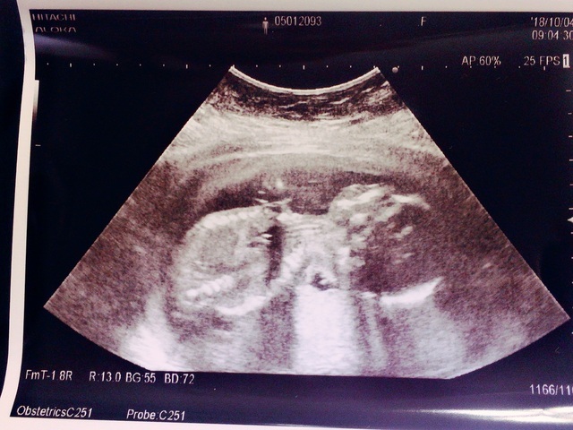 エコー写真 19週3日 19w3d 女の子,妊娠19週,エコー,