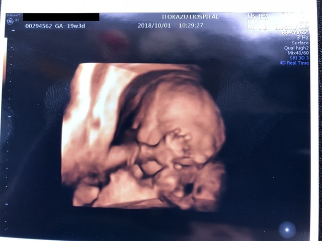 エコー写真 19週3日 19w3d 女の子,妊娠19週,エコー,