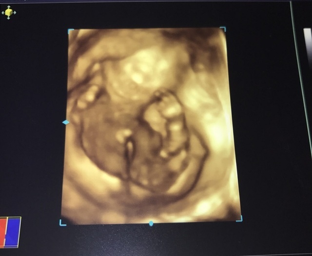 エコー写真 19週3日 19w3d 女の子,妊娠19週,エコー,