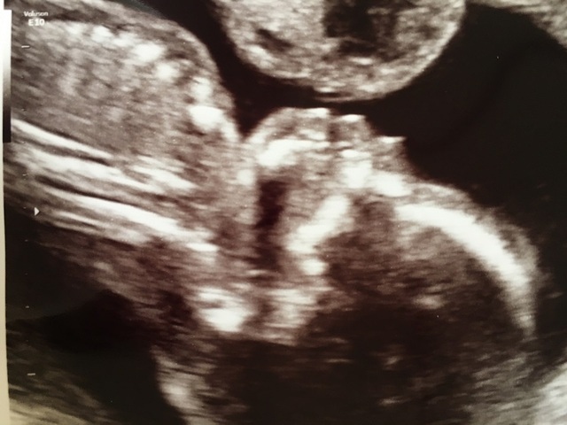 エコー写真 19週3日 19w3d 男の子,妊娠19週,エコー,