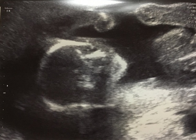 エコー写真 19週4日 19w4d 女の子,妊娠19週,エコー,