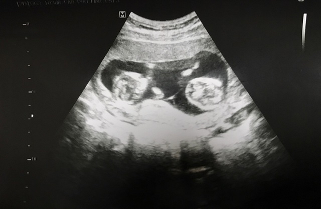 エコー写真 19週5日 19w5d 男の子,妊娠19週,エコー,