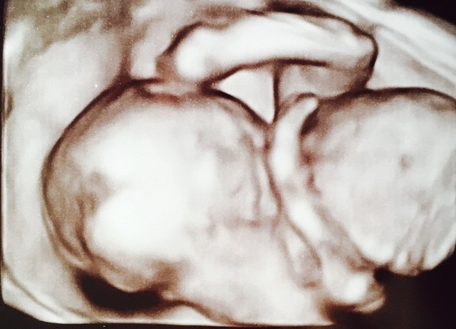 エコー写真 19週5日 19w5d 女の子,妊娠19週,エコー,